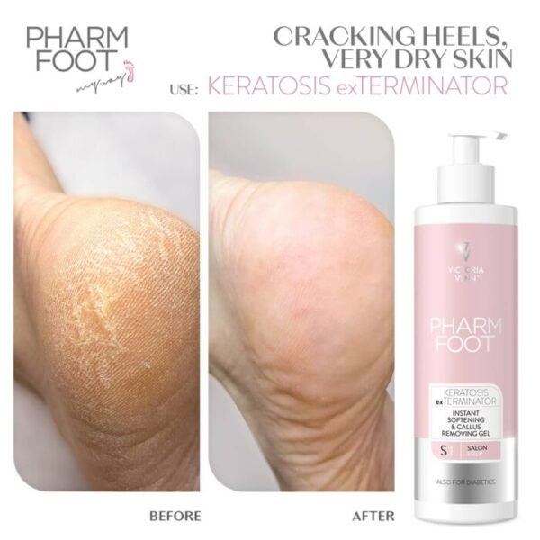 ⁦Pharm Foot | KERATOSIS exTERMINATOR ג’ל ריכוך להסרת קאלוס ועור יבש⁩ – תמונה ⁦3⁩